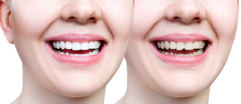 The Real Cost Of Fixing One Chipped Tooth Before Graduation