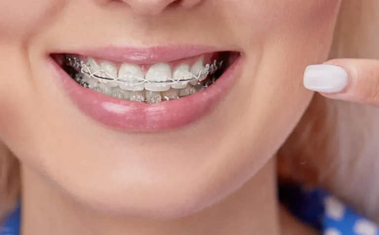 The Questions Every Parent Should Ask Before Choosing Braces or Clear Aligners